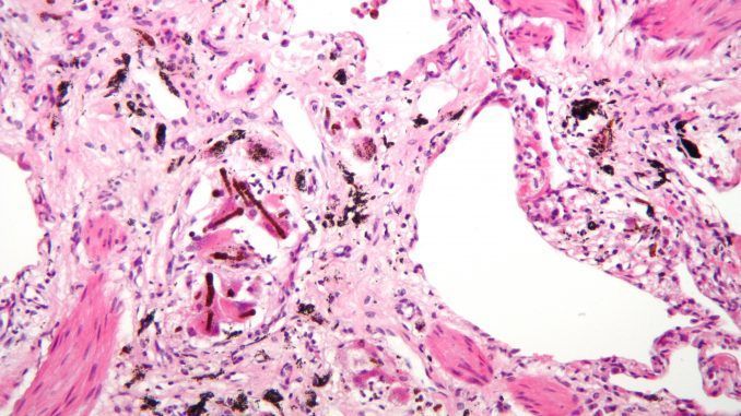 ¿Tienen los pacientes con asbestosis mayor riesgo de fallecer por covid?